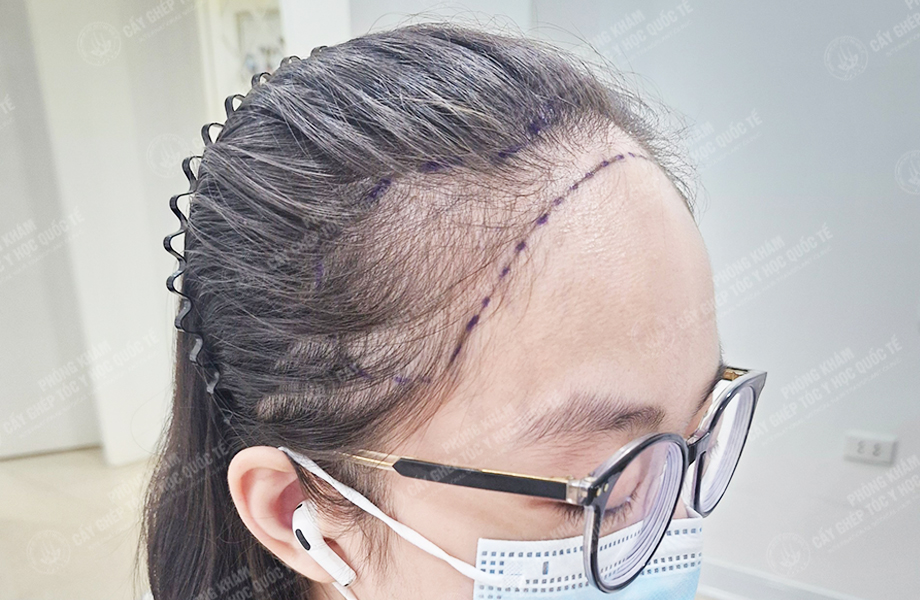 Nguyễn Thị Thơ - Cấy tóc đường chữ M 2
