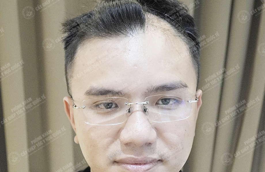 Nguyễn Quốc Hưng - Cấy tóc đường chữ M 2