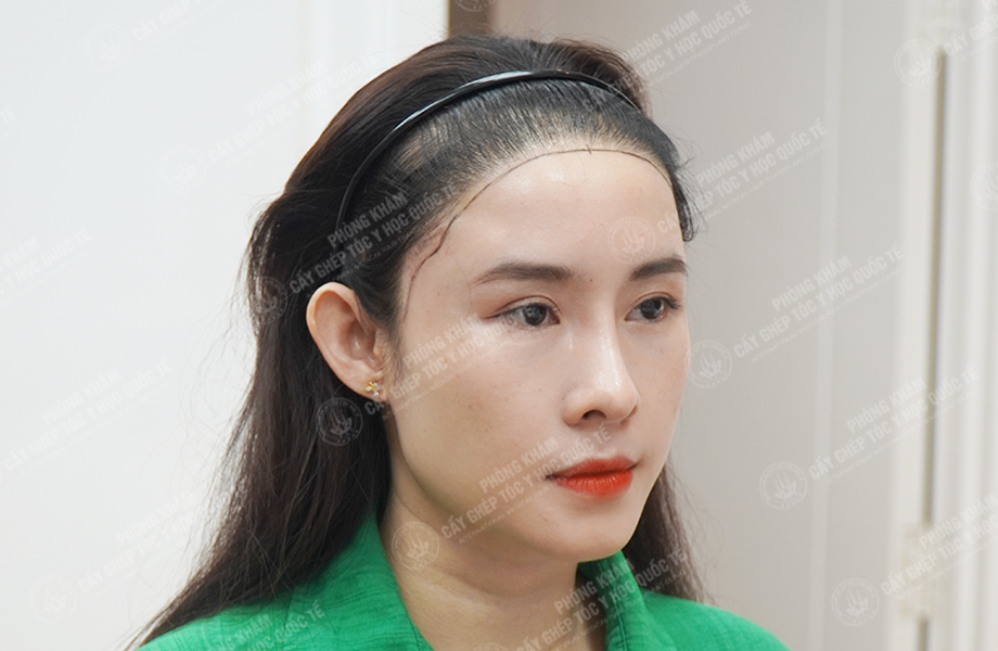 Nguyễn Ngọc Ngà - Cấy tóc tự thân 2