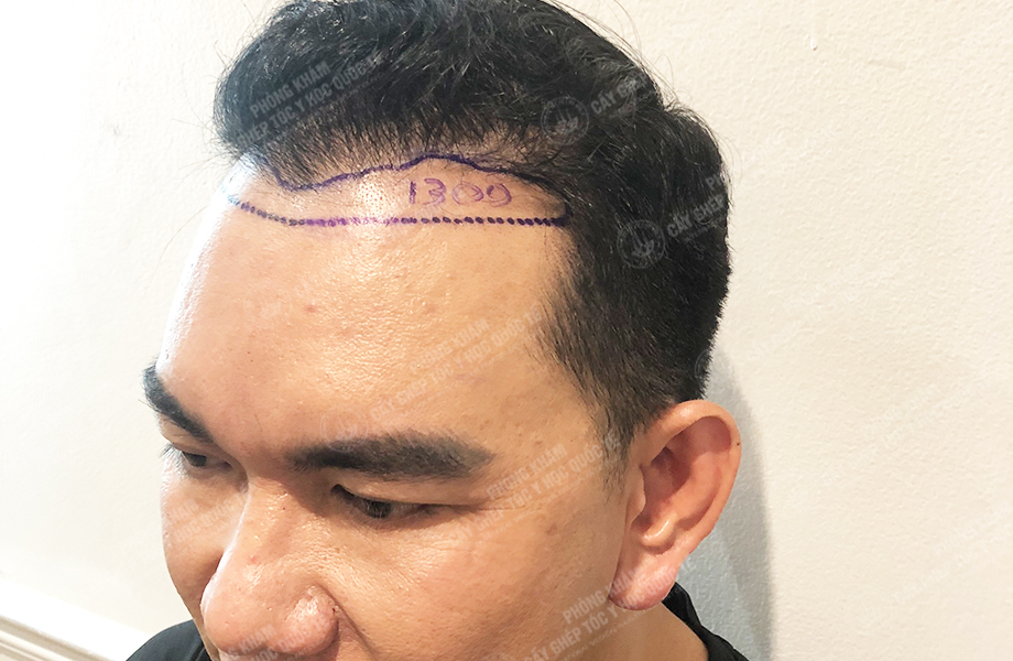 Đỗ Văn  Nhân - Cấy tóc đường chữ M 2