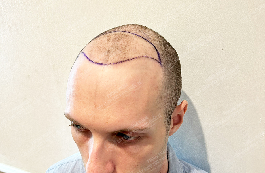 SONNY - Cấy tóc đường chữ M 2