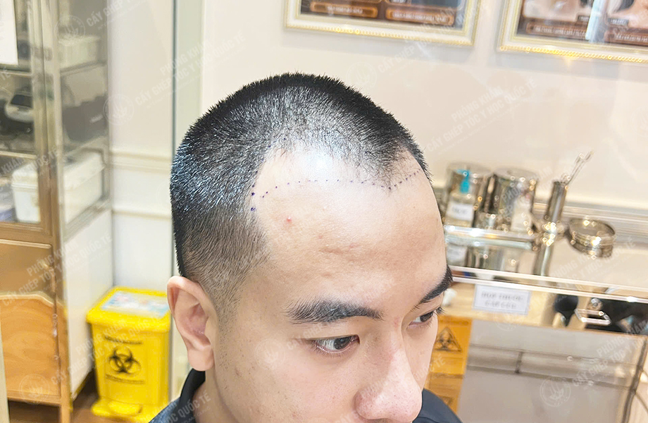 Nguyễn Nhật Hoàng - Cấy tóc đường chữ M 2