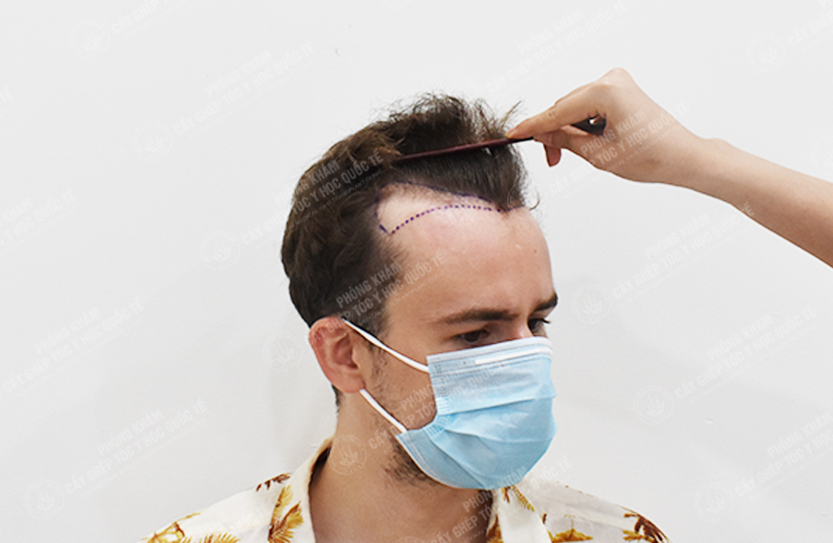 Leo Parry - Cấy tóc đường chữ M 2