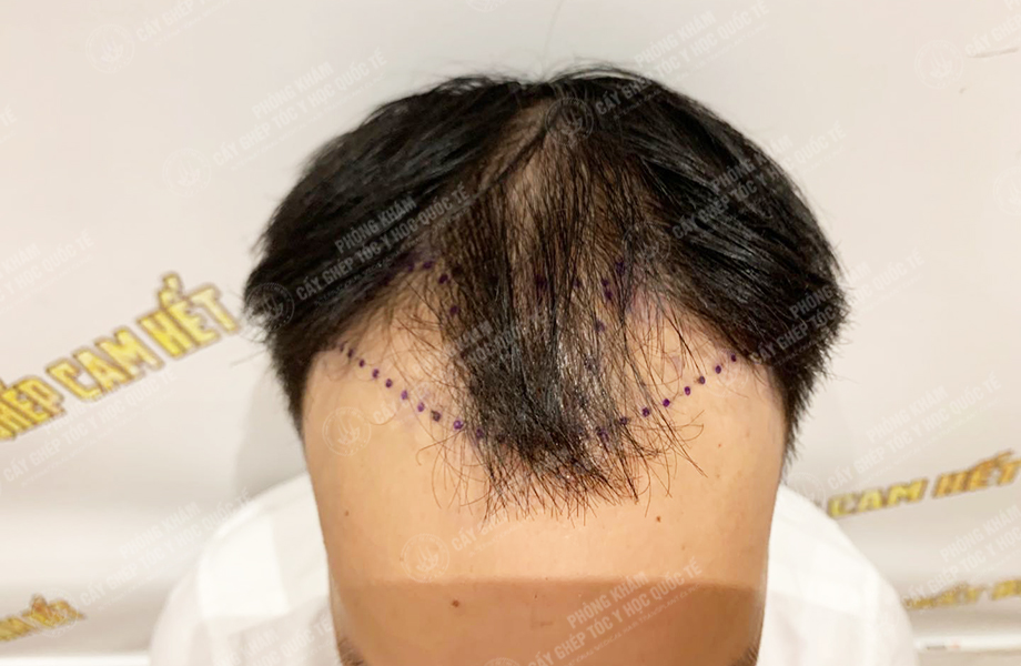 Hoàng Thái Sơn - Cấy tóc đường chữ M 2