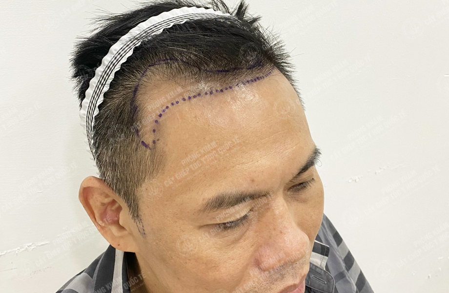 Đào Văn Minh - Cấy tóc đường chữ M 2