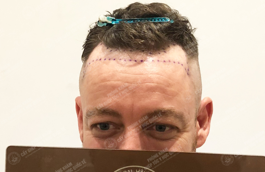 JAME SON - Cấy tóc đường chữ M 2