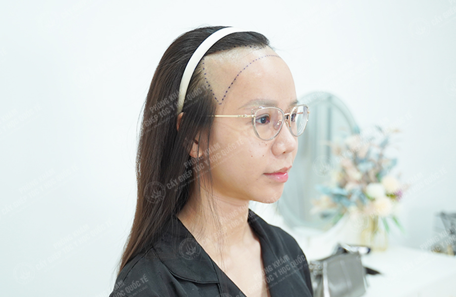 Nguyễn Minh Trang - Cấy tóc đường chữ M 2