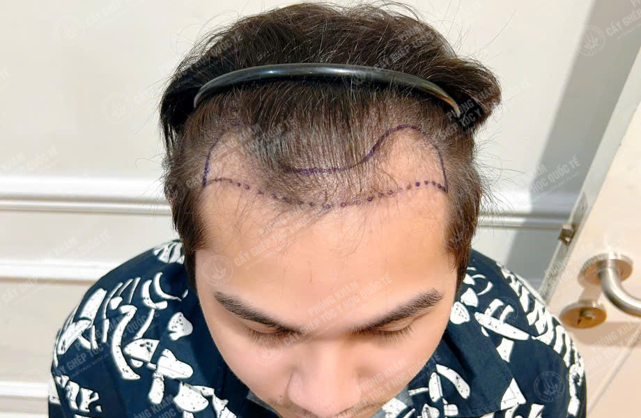 Nguyễn Minh Quân - Cấy tóc đường chữ M 2