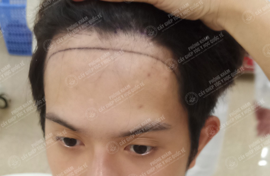 Nguyễn Hoàng Hưng - Cấy tóc đường chữ M 2