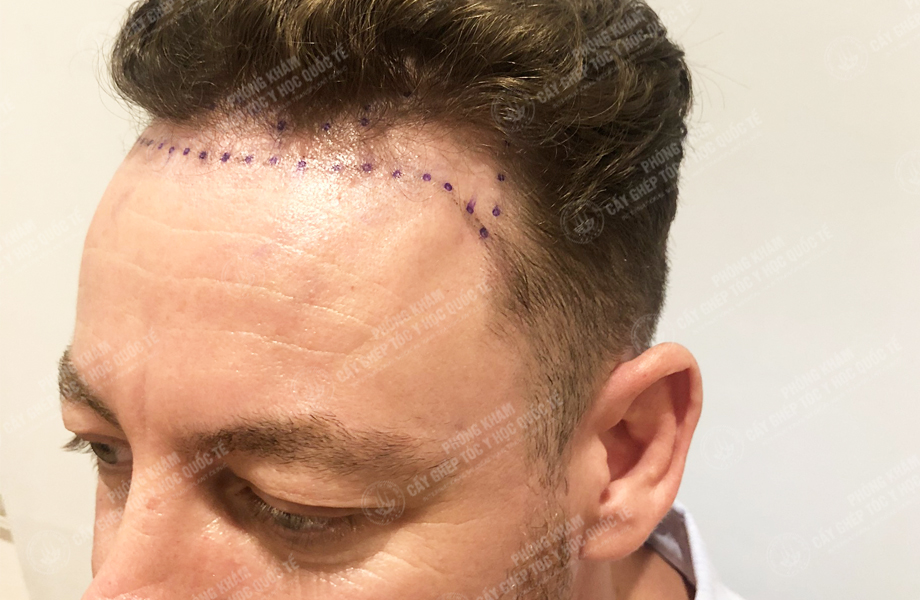 Jay Son - Cấy tóc đường chữ M 2