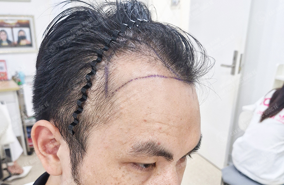 Đỗ Thanh Nhân - Cấy tóc đường chữ M 2