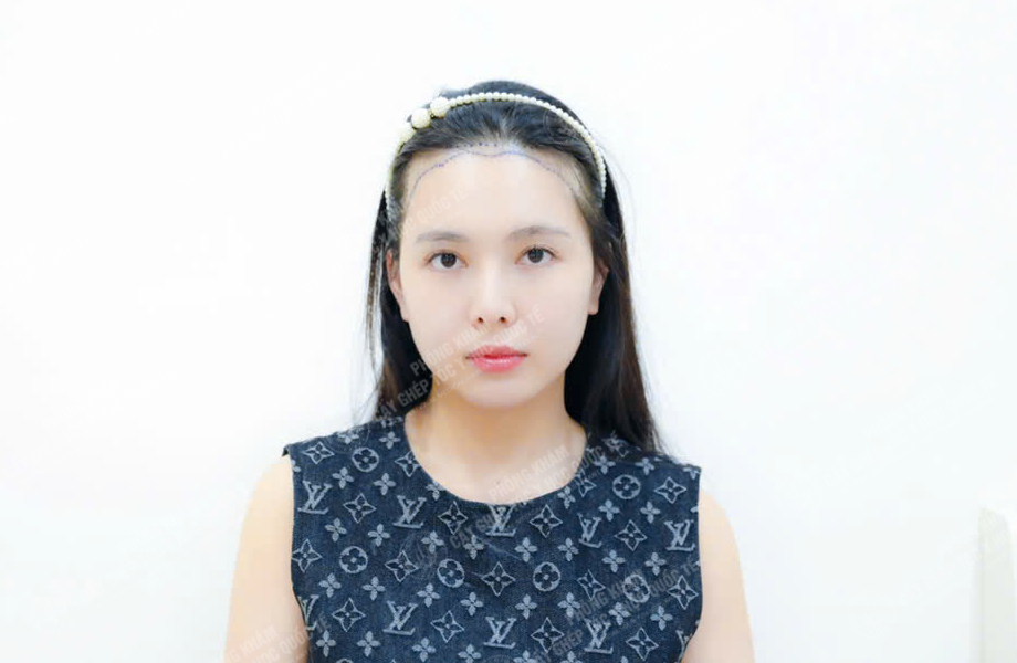 Đào Thị Phương - Cấy tóc đường chữ M 2