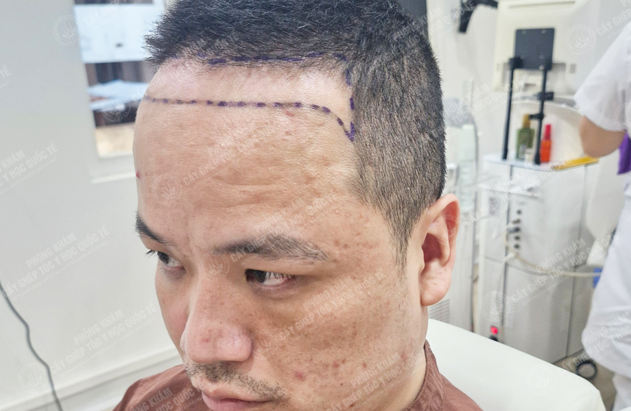 Lê Thanh Ngọc - Cấy tóc đường chữ M 2