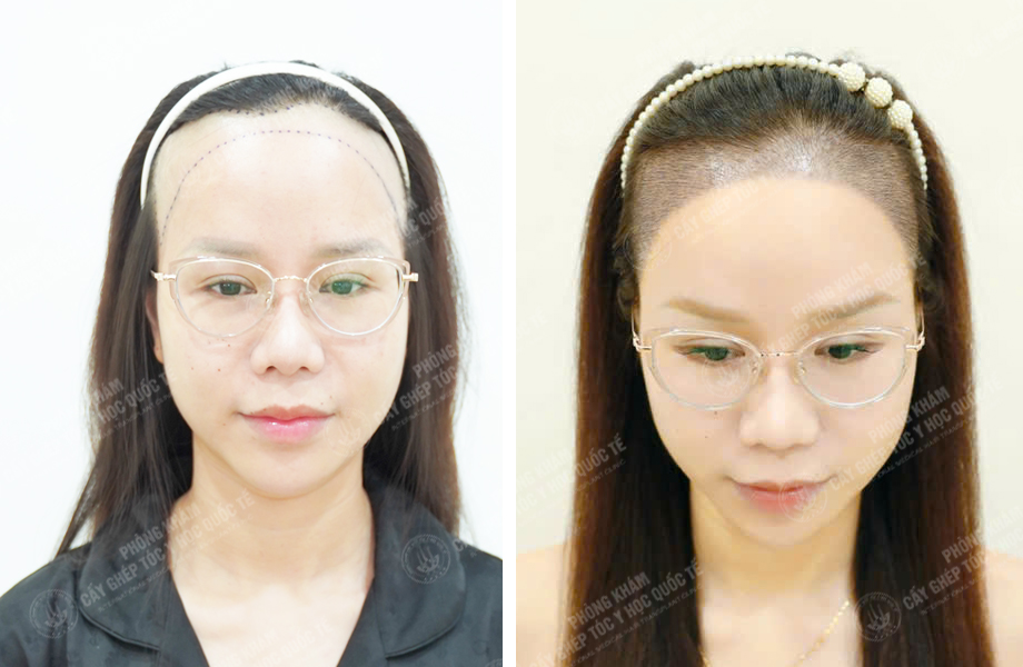  Nguyễn Minh Trang - Cấy tóc đường chữ M 1