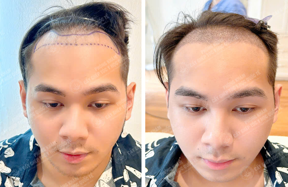  Nguyễn Minh Quân - Cấy tóc đường chữ M 1