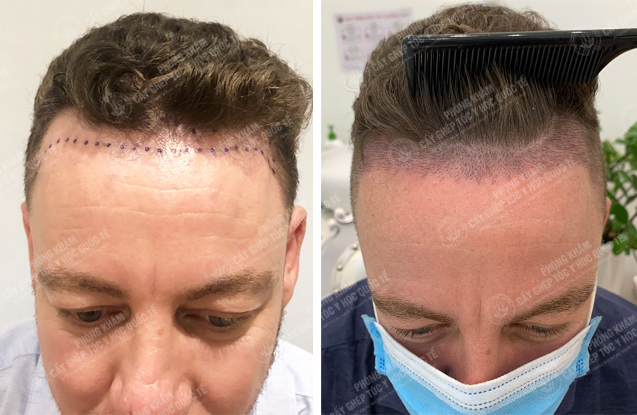  Jay Son - Cấy tóc đường chữ M 1