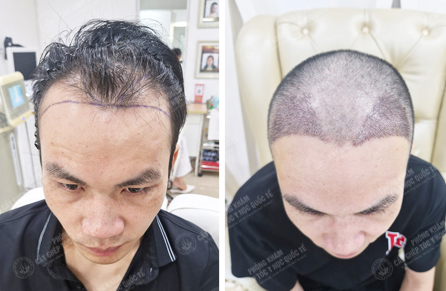  Đỗ Thanh Nhân - Cấy tóc đường chữ M 1