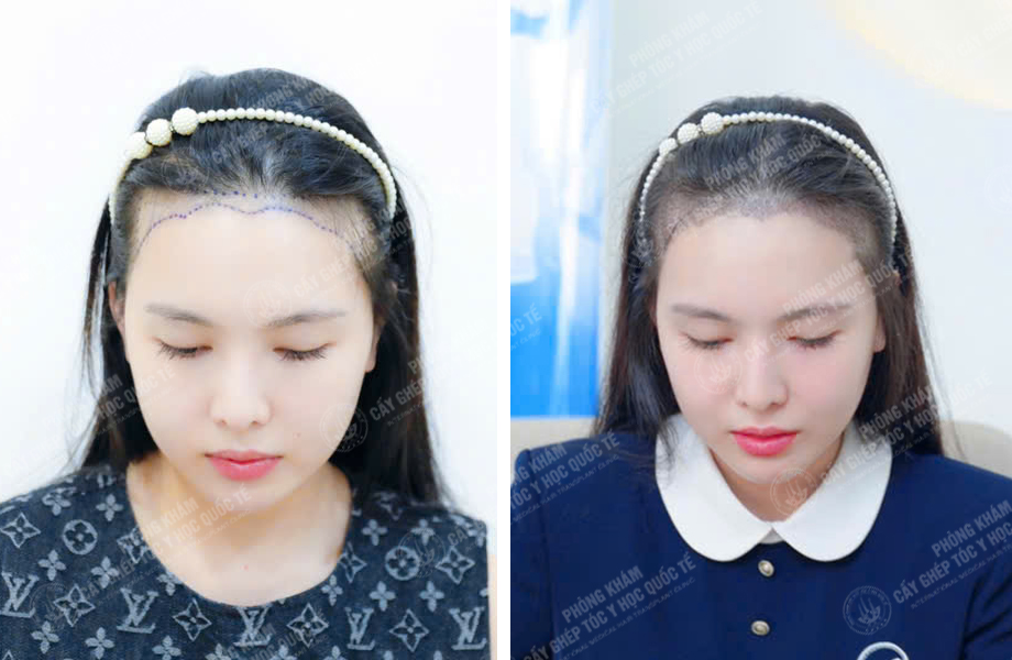  Đào Thị Phương - Cấy tóc đường chữ M 1