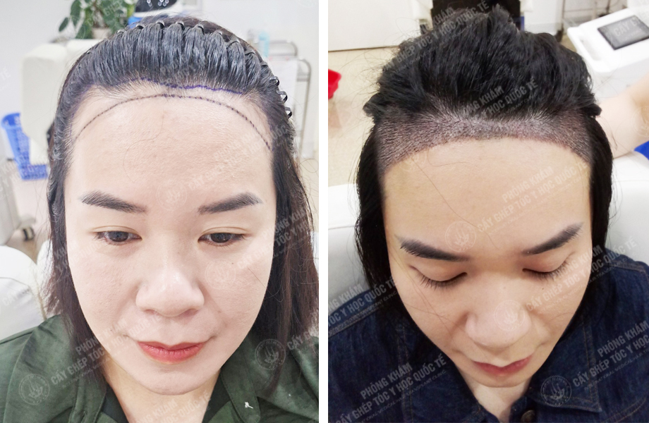  Đỗ Thị Hạnh - Cấy tóc tự thân 1
