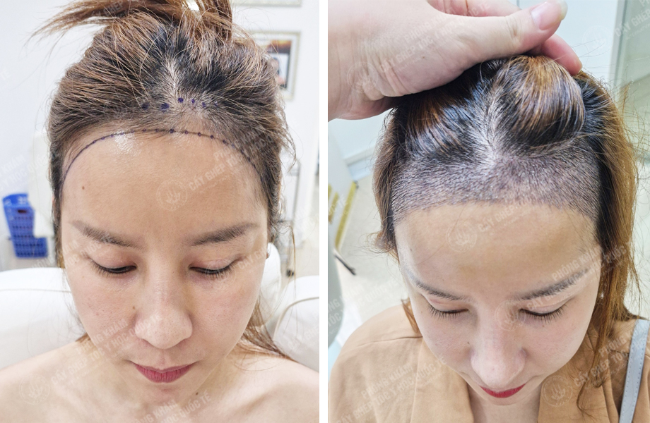  Ngô Thị Hồng - Cấy tóc đường chữ M 1
