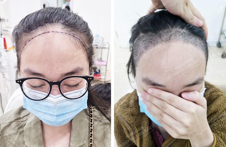  Nguyễn Thị Thơ - Cấy tóc đường chữ M 1