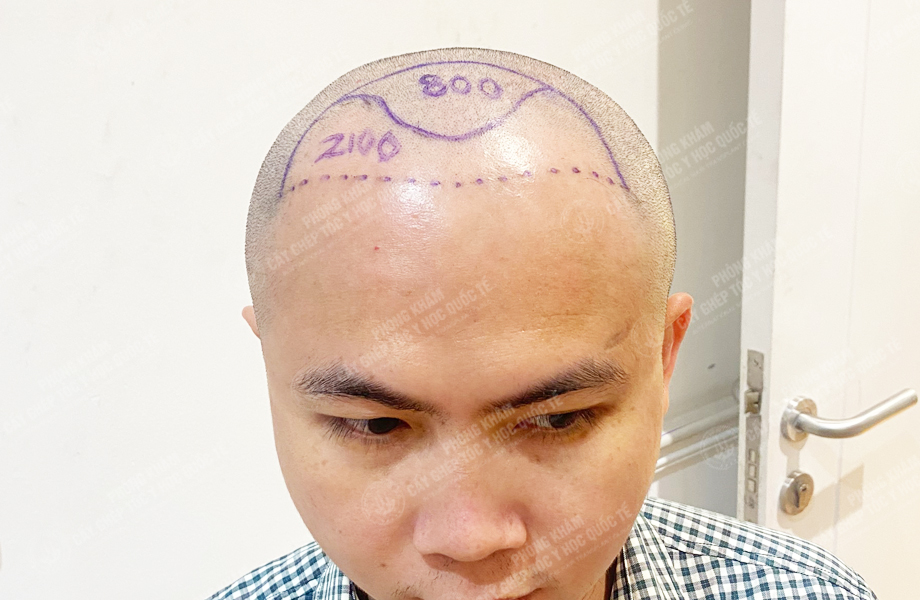 Bùi Văn Lanh - Cấy tóc đường chữ M 3