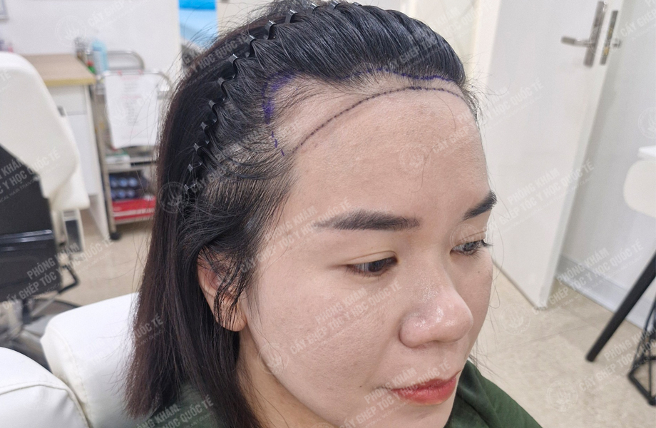 Đỗ Thị Hạnh - Cấy tóc đường chữ M 3