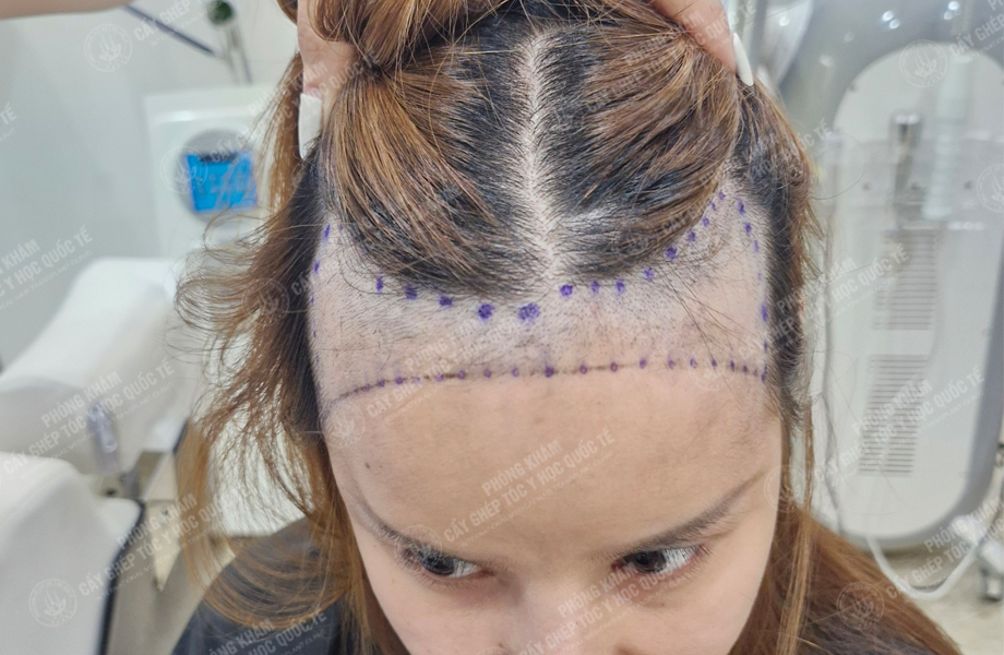 Ngô Thị Hồng - Cấy tóc đường chữ M 3