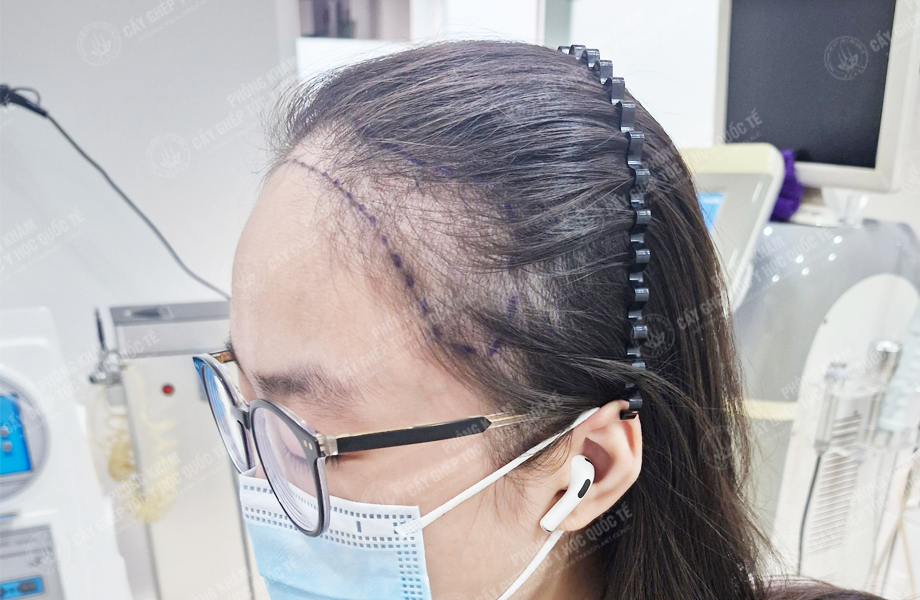 Nguyễn Thị Thơ - Cấy tóc đường chữ M 3