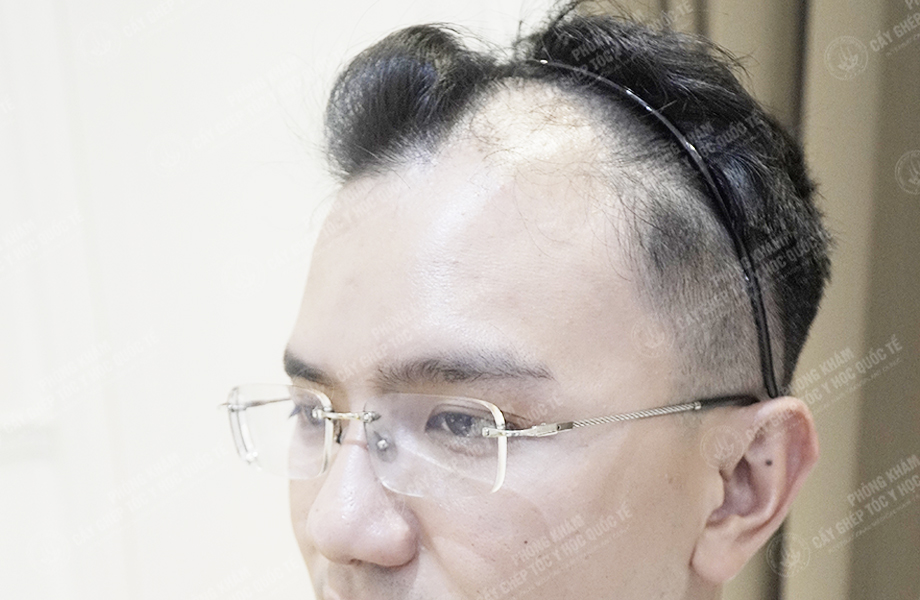 Nguyễn Quốc Hưng - Cấy tóc đường chữ M 3