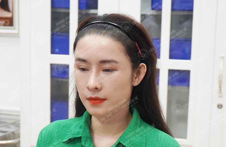 Nguyễn Ngọc Ngà - Cấy tóc tự thân 3