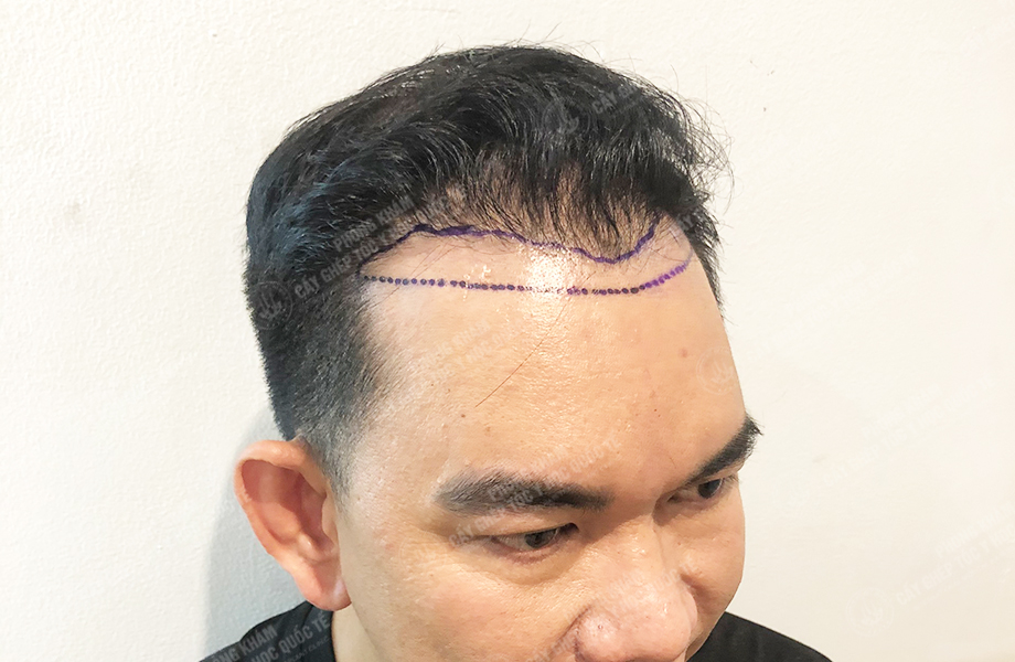 Đỗ Văn  Nhân - Cấy tóc đường chữ M 3