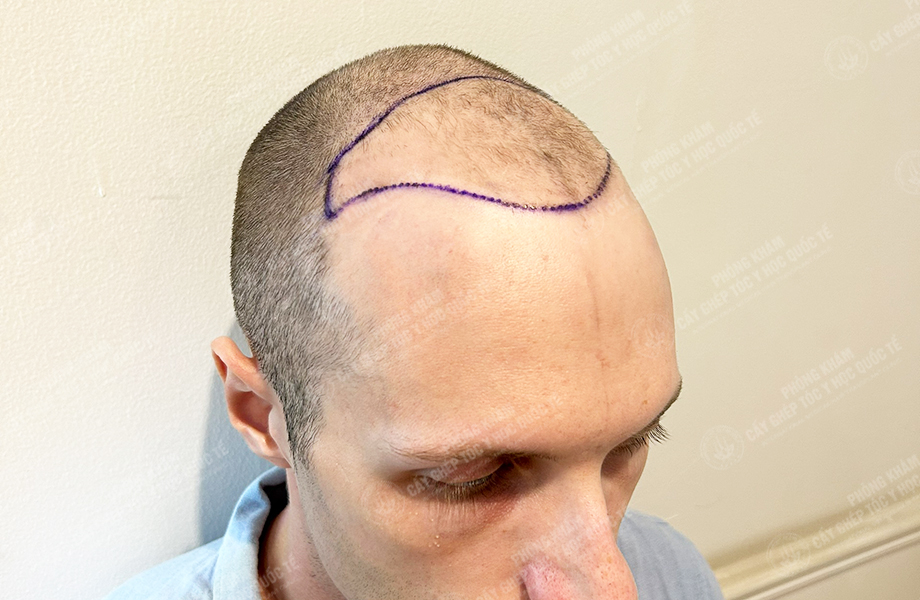 SONNY - Cấy tóc đường chữ M 3