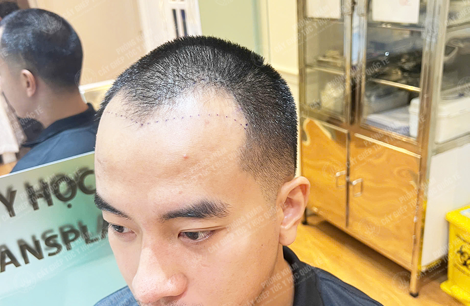 Nguyễn Nhật Hoàng - Cấy tóc đường chữ M 3