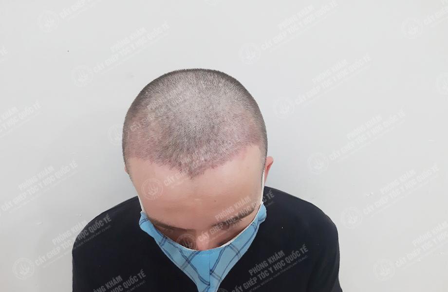 Leo Parry - Cấy tóc đường chữ M 3