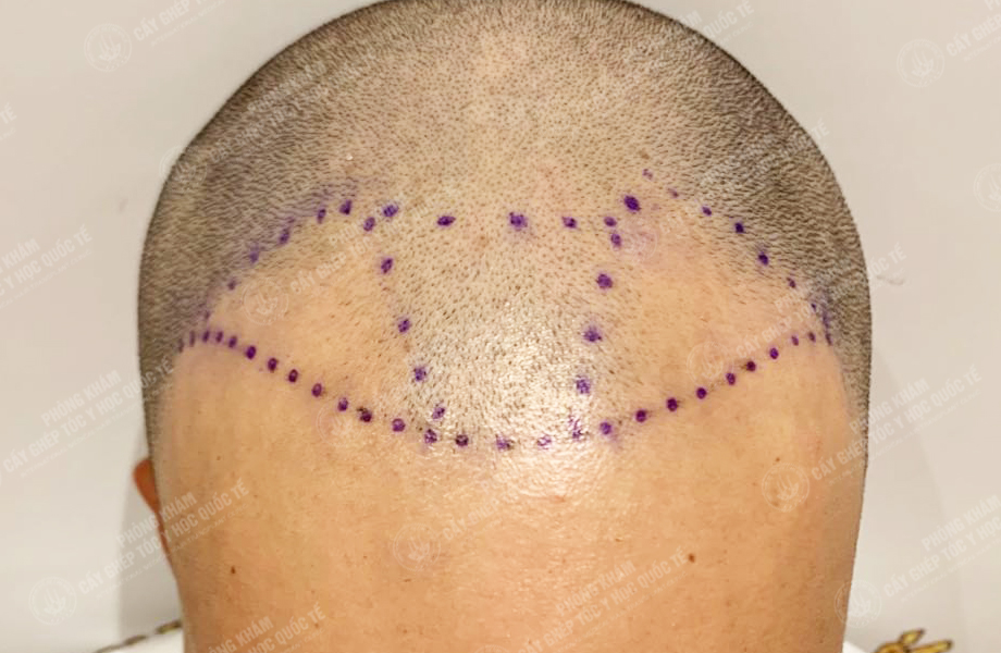 Hoàng Thái Sơn - Cấy tóc đường chữ M 3