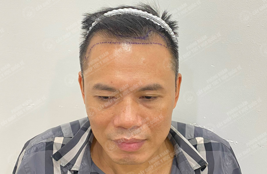 Đào Văn Minh - Cấy tóc đường chữ M 3