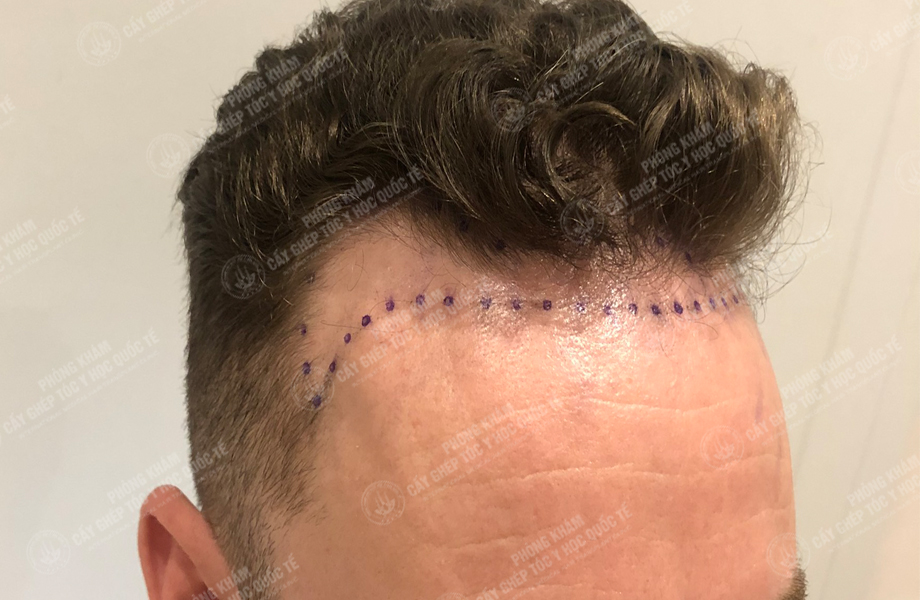 JAME SON - Cấy tóc đường chữ M 3