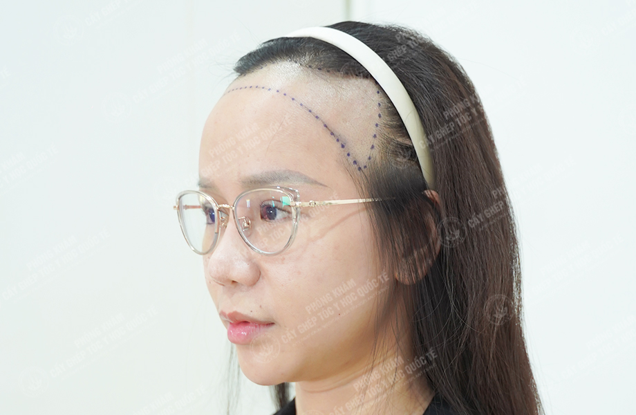 Nguyễn Minh Trang - Cấy tóc đường chữ M 3