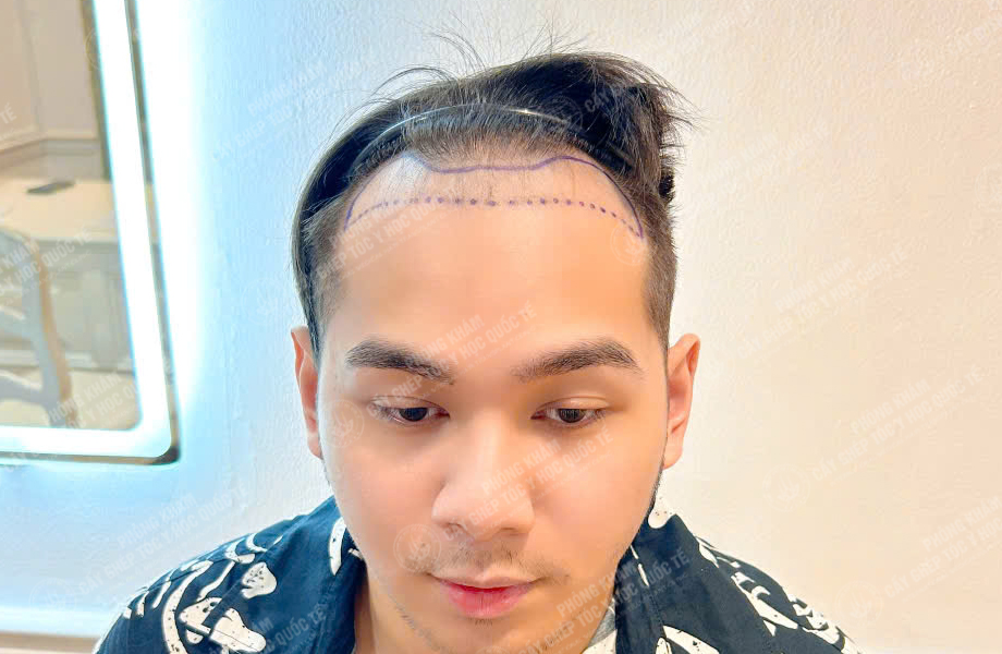 Nguyễn Minh Quân - Cấy tóc đường chữ M 3