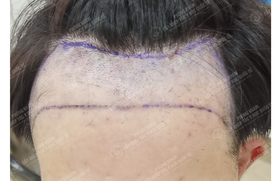 Nguyễn Hoàng Hưng - Cấy tóc đường chữ M 3