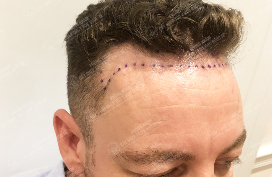 Jay Son - Cấy tóc đường chữ M 3