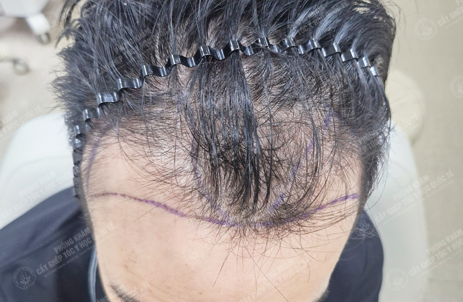 Đỗ Thanh Nhân - Cấy tóc đường chữ M 3