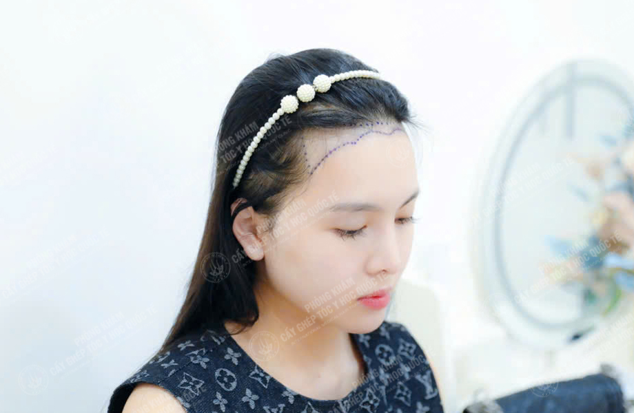 Đào Thị Phương - Cấy tóc đường chữ M 3