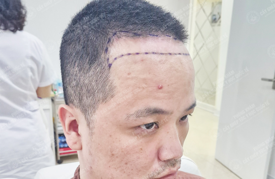 Lê Thanh Ngọc - Cấy tóc đường chữ M 3