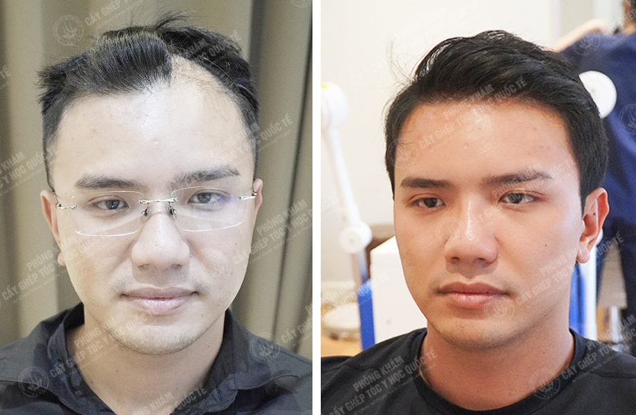  Nguyễn Quốc Hưng - Điều chỉnh đường chân tóc 1