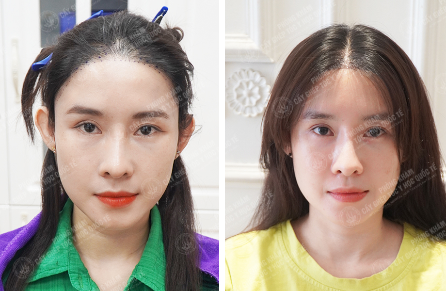  Nguyễn Ngọc Ngà - Cấy tóc tự thân 1