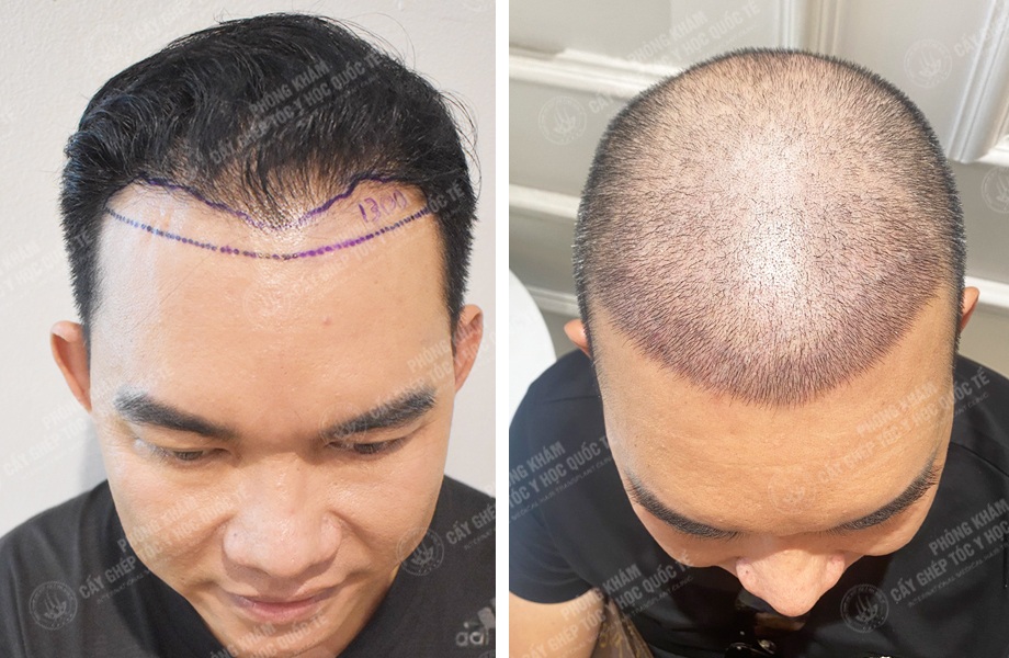  Đỗ Văn  Nhân - Cấy tóc đường chữ M 1