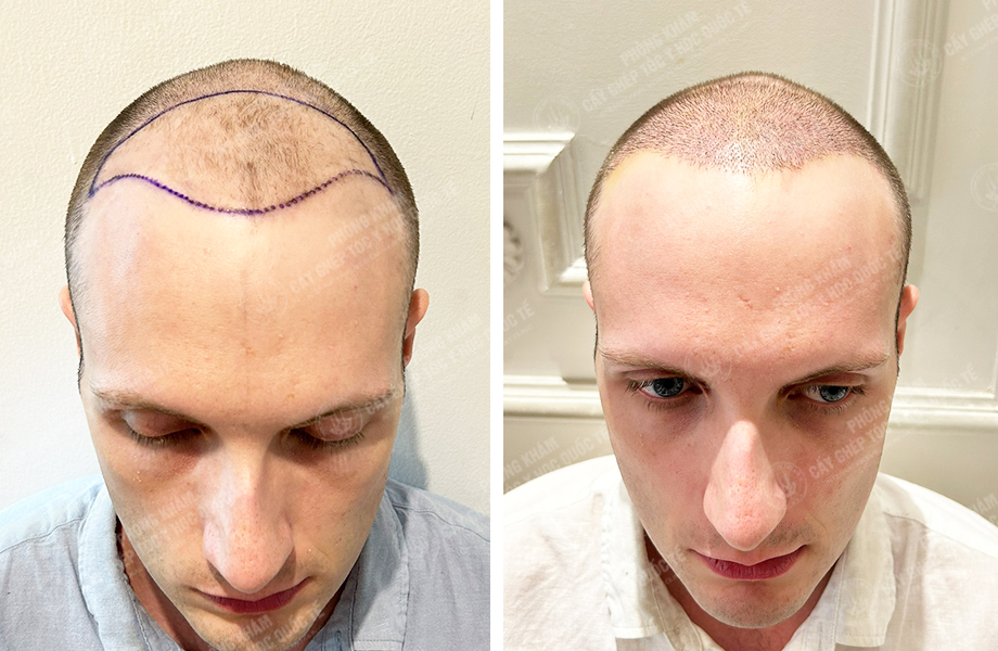  SONNY - Cấy tóc đường chữ M 1