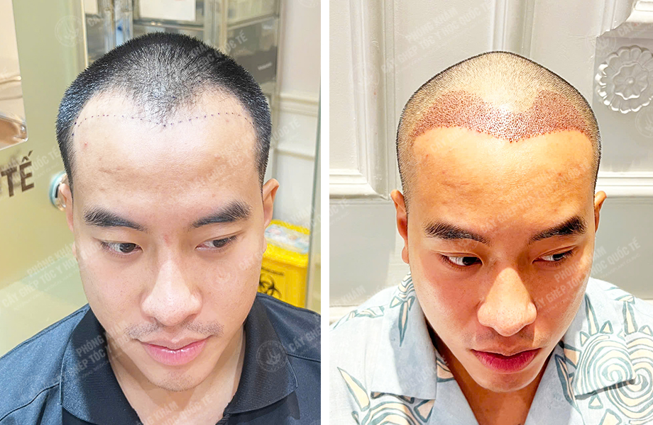  Nguyễn Nhật Hoàng - Cấy tóc đường chữ M 1
